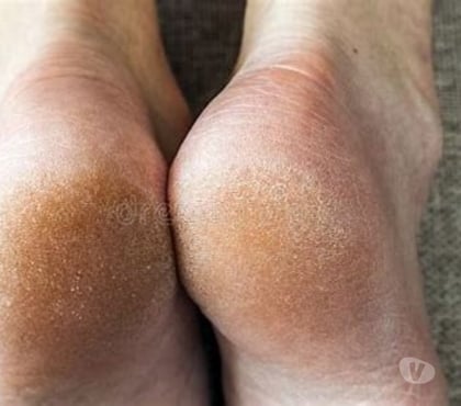  massage Westcliff-on-Sea Southend-on-Sea - Photos for ESSEX SS0 NON SMOKERS ONLY FOOT PEDICURES BODY SCRUBS